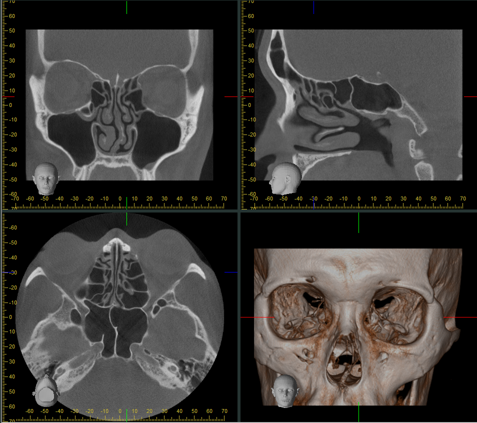 田無耳鼻咽喉科クリニック　CT画像